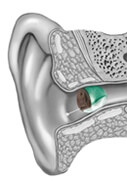 iic-hearing-aid